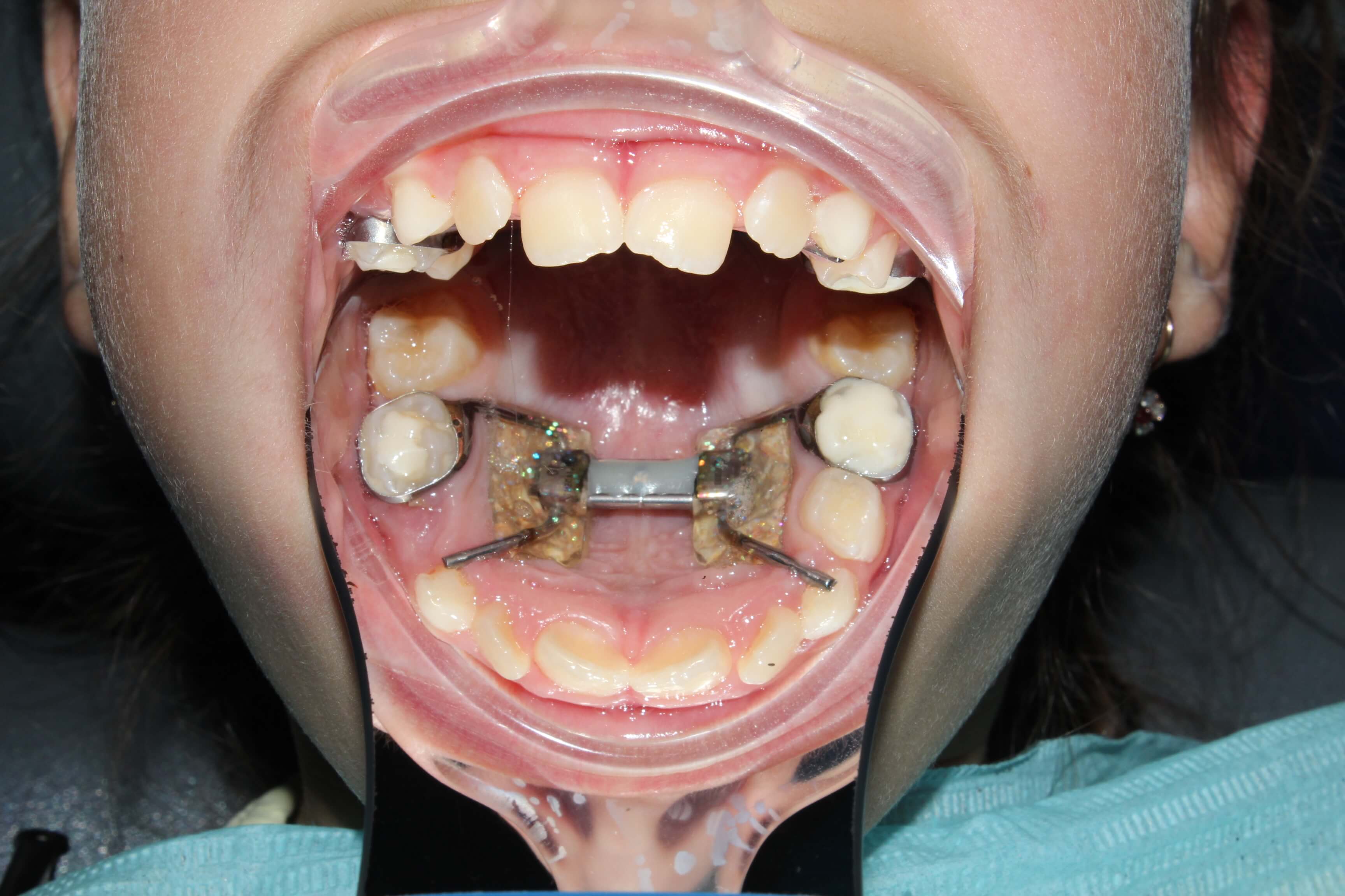 Исправление прикуса у детей с помощью пластинок | Блог Кремлевской стоматологии