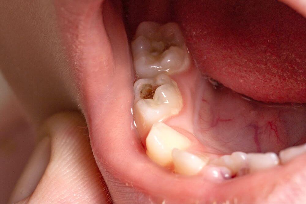 Болезни зубов у детей: симптомы распространенных недугов