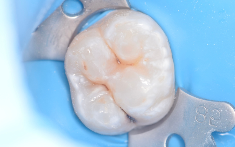 Лечение кариеса и пульпита