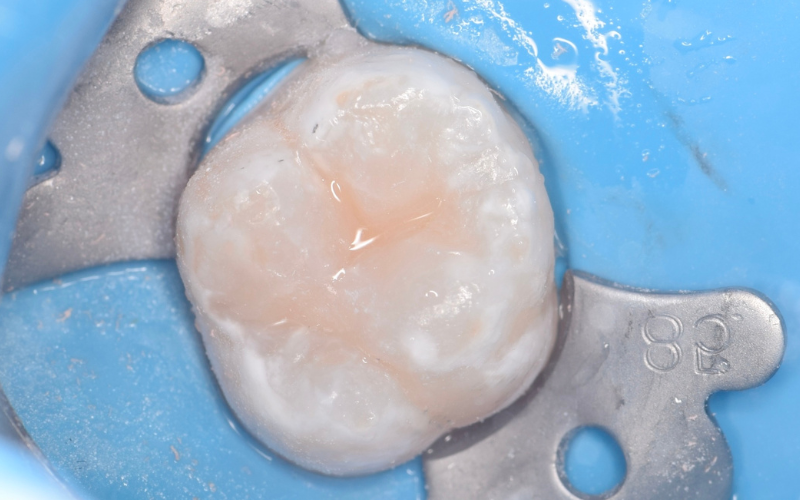 Лечение кариеса и пульпита